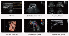 Chison EBit 30 Portable Ultrasound For Sale